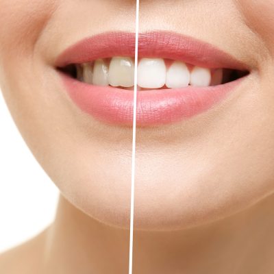 Result of teeth whitening. Smiling young woman on white background, closeup