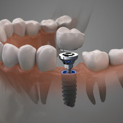 Implantologia, Impianti dentari